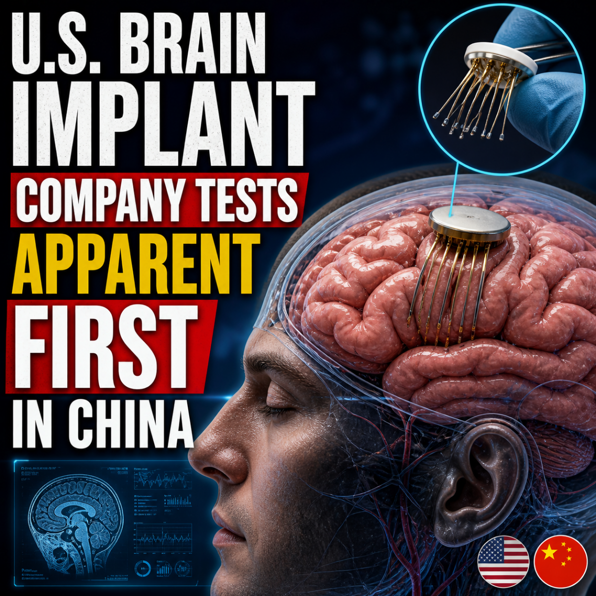 U.S. Brain Implant Company Tests Device In China – News Watchmen